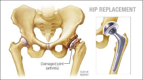 Hip Replacement - used with the permission from www.mayoclinic.org